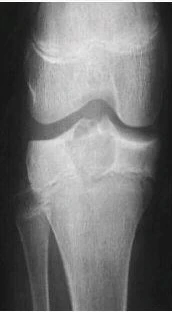 Epiphyseal Tumors bone tumor