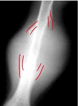 Ewing sarcoma bone tumor