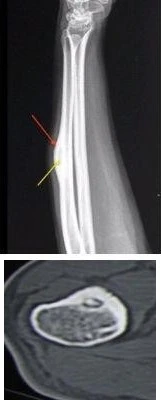 Osteoid-osteoma-bone-tumor