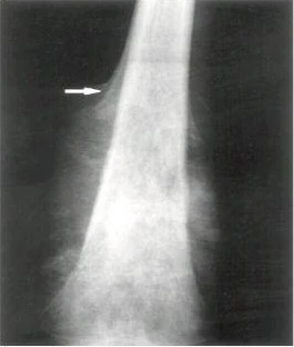 Osteosarcoma bone tumor