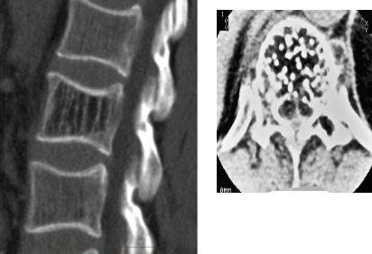 Spinal Hemangioma