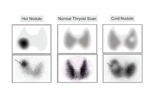 Absolute C/I for Radioactive Iodine Ablation 