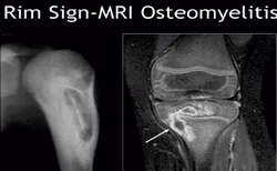 TOM SMITH ARTHRITIS – HYPERMOBILE HIP 