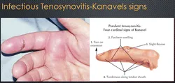 PURULENT TENOSYNOVITIS: KANAVEL SIGN  