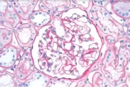 Post Streptococcal Glomeruli-Nephritis