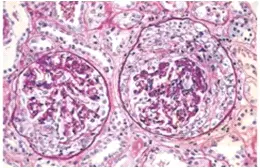 Crescentic Glomerulonephritis