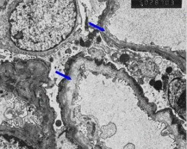 Alport Syndrome