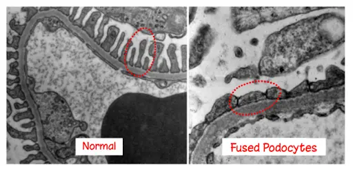 Minimal Change Disease