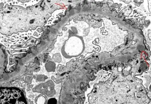 Membranous Glomerulopathy