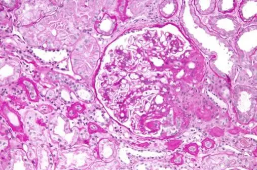 Focal Segmental Glomerulosclerosis