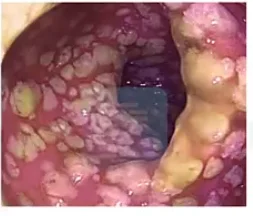 Psuedo membraneous colitis