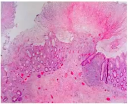 Psuedo membraneous colitis microscopic view