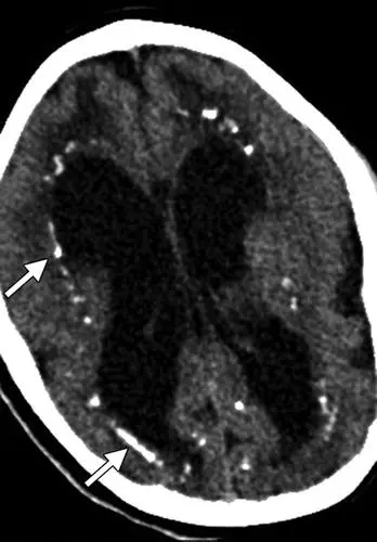 Periventricular Calcification infections in pregnancy