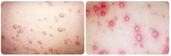 Varicella Zoster Infections in pregnancy