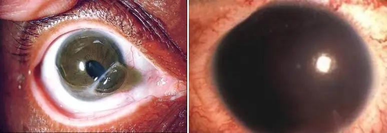 palpebral conjunctiva