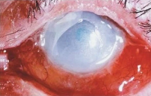 CHEMICAL INJURIES OF EYE 