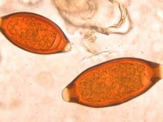 Trichuris Trichiura