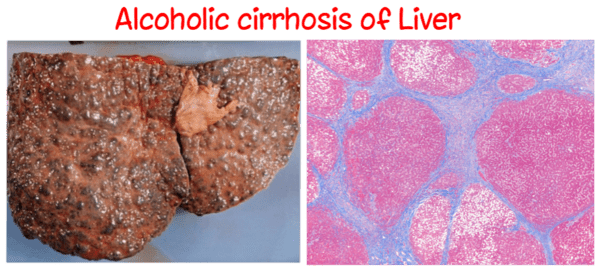 Alcoholic Liver Cirrhosis (Laennec's Cirrhosis)