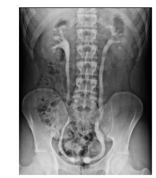 retroperitoneal fibrosis ivp