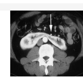 Horseshoe Kidney  