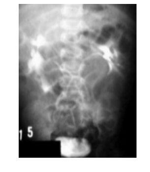 Polycystic kidney disease (Autosomal dominant)
