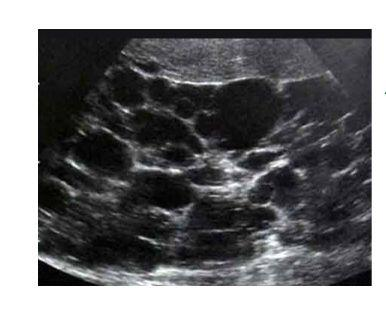 Polycystic kidney disease (Autosomal dominant).