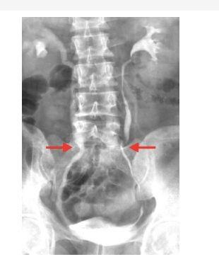 Retroperitoneal fibrosis 