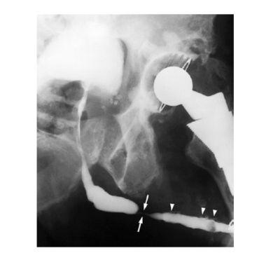 Retrograde urethrogram 1