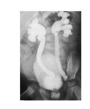 Vesicoureteral reflux 