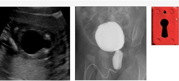 Grade 5 vesico ureteric reflux