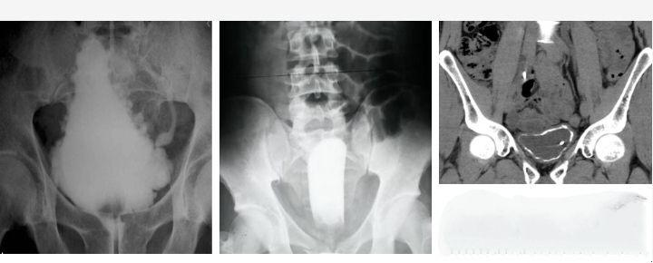 Bladder appearances in different conditions