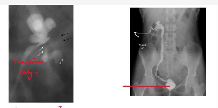 Genitourinary TB