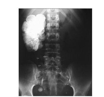 Thimble bladder 