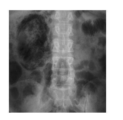 Emphysematous pyelonephritis 