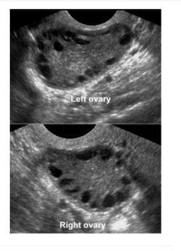 PCOS