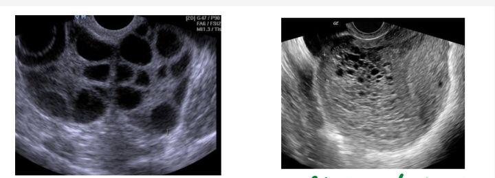 OHSS vs Theca Lutein Cyst 