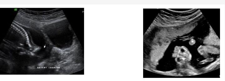 Anencephaly 