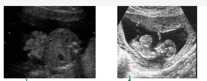 Gastroschisis 				Omphalocele