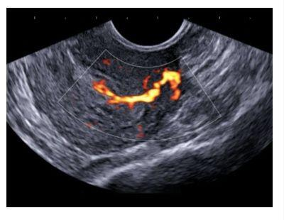 Endometrial polyp