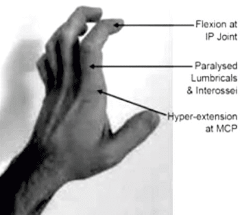 Paralysis of lumbricals    