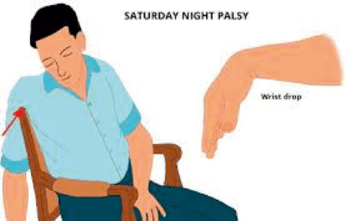 Saturday night palsy/Crutch palsy/Honeymoon palsy