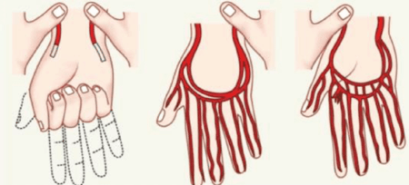 Upper Limb, Nerve Injury - NEET PG Orthopedics