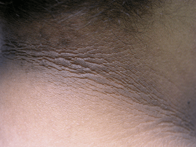 Acanthosis Nigricans