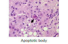 Pathological apoptosis is seen in 