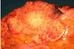 Infiltrating Ductal Carcinoma