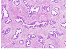  Pericanalicular fibroadenoma