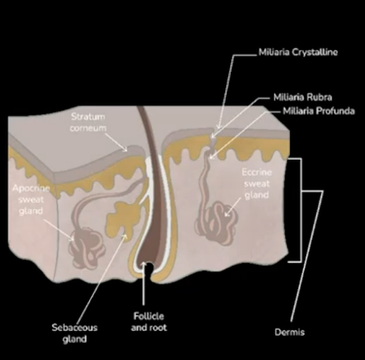 Miliaria (IMP)
