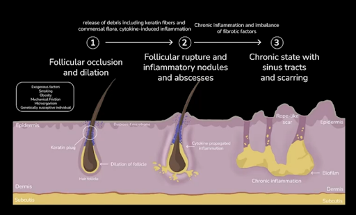 Pathophysiology of HS
