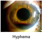 Hyphema 