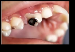 indicates dental fluorosis